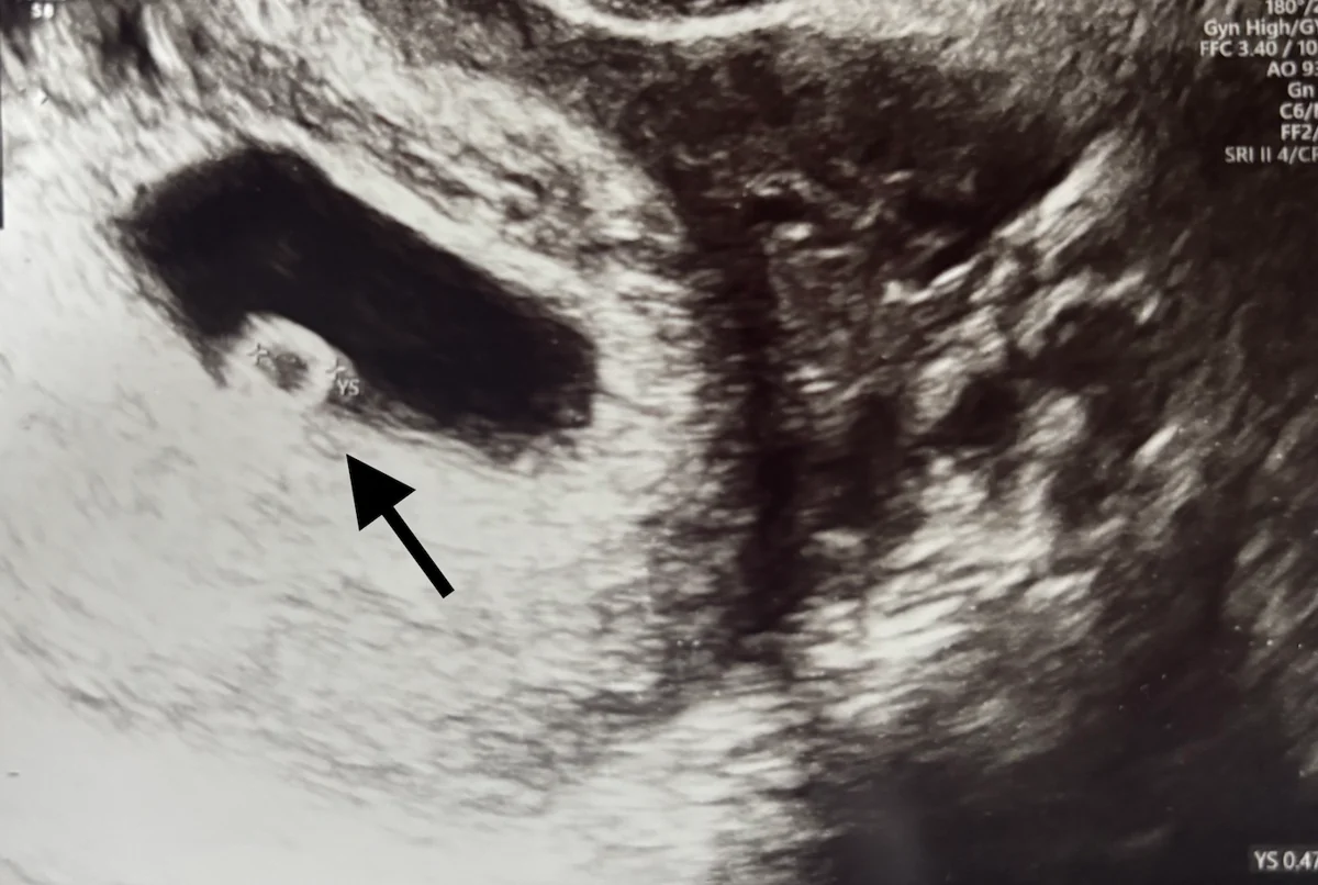 Early ultrasound image of a developing baby